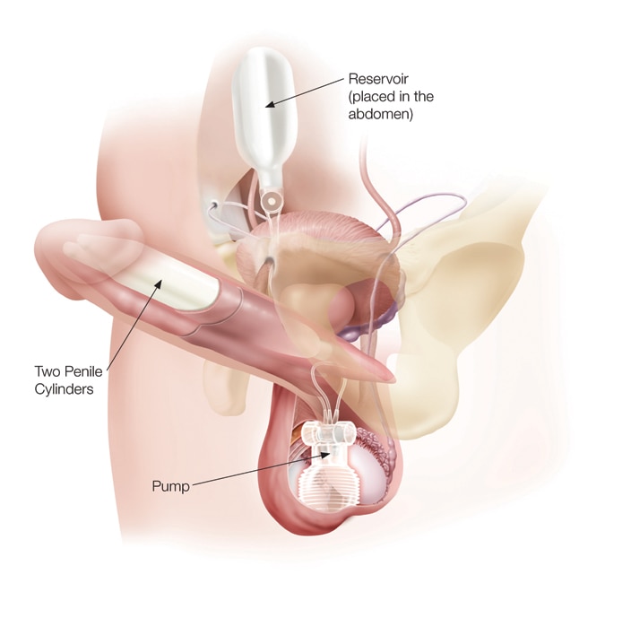 Silicone Penis Implant 58