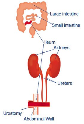 Urostomy