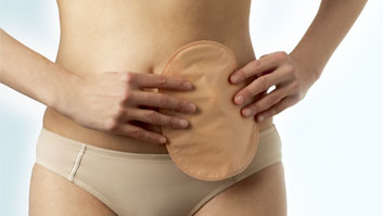 Why do I need to wear an ostomy pouching  system? 