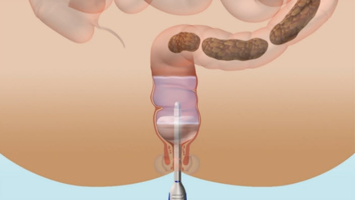 Transanal irrigation and Peristeen®