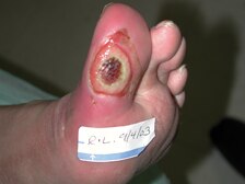 Infected foot ulcer