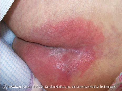 Pressure ulcer Category/Stage I: Non-blanchable redness of intact skin