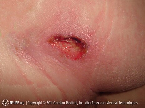 Pressure ulcer Category/Stage III: Full thickness skin loss (fat visible)