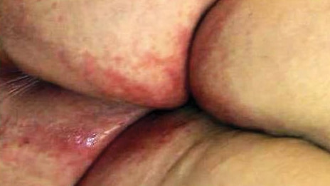 Incontinece-associated dermatitis (IAD) Incontinece-associated dermatitis (IAD)