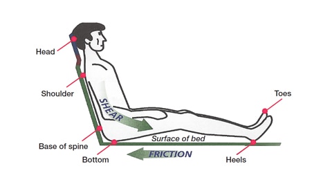 Where do pressure ulcers occur?