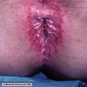 pruritus ani, itchy butt pruritus ani, itchy butt