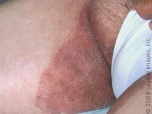 tinea cruris tinea cruris