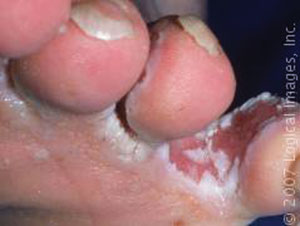 Athlete's foot Athlete's foot