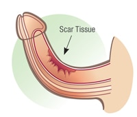 penis scar tissue penis scar tissue