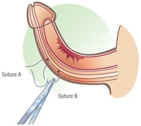 penile straightening