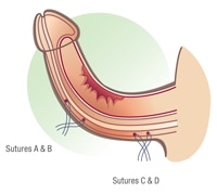 penile surgery