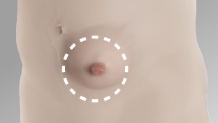 Abdomen shown of someone that has a body profile with an outward area around the stoma