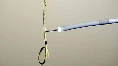 Isiris® is designed for stent removal procedure